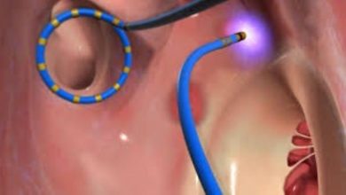 Cardiac Ablation in Singapore: The Future of Treating Arrhythmia