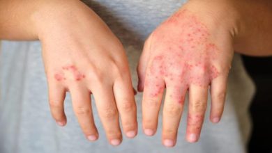 Eczema: Causes, Prevention, and Finding the Right Treatment in Singapore
