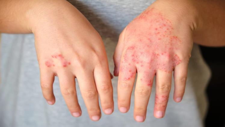 Eczema: Causes, Prevention, and Finding the Right Treatment in Singapore
