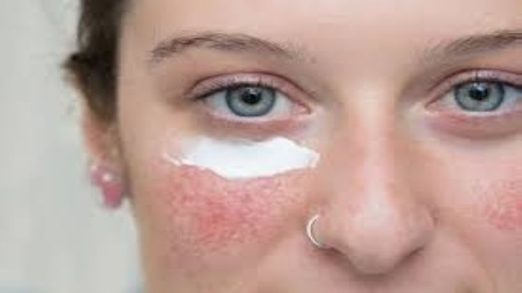 How Medical Spas Choose The Right Treatment For Rosacea Prone Skin